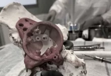 Новосибирские специалисты напечатали уникальный 3D-протез кости таза 70-летней пациентке