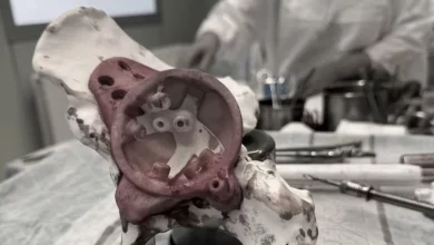 Новосибирские специалисты напечатали уникальный 3D-протез кости таза 70-летней пациентке
